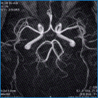 MRA検査画像例